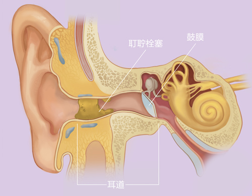 若耳屎分泌过多或排出受阻,阻塞于外耳道内,长期以往就形成了耵聍栓塞