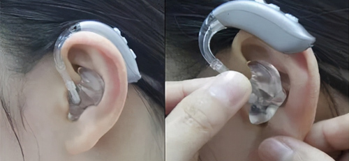 助听器定制耳模